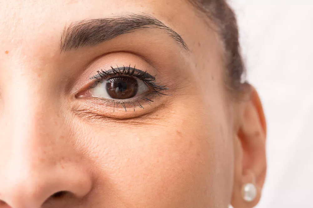 Come combattere le borse sotto gli occhi